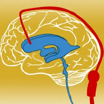Ventriculoperitoneal Shunt graphical drawing.