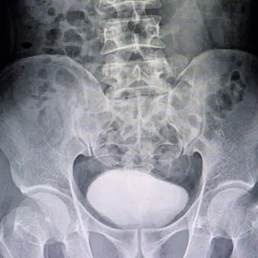 Voiding Cystourethrograms scan