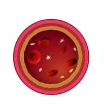 Immune Thrombocytopenia Purpura graphic