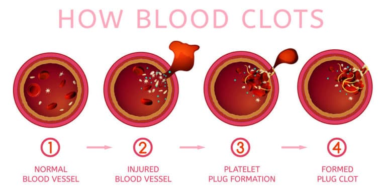 Immune Thrombocytopenia Purpura (ITP) graphic