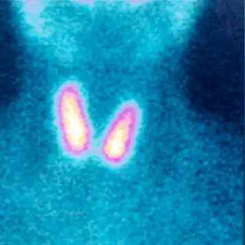 Child's thyroid appearing in scan with iodine.