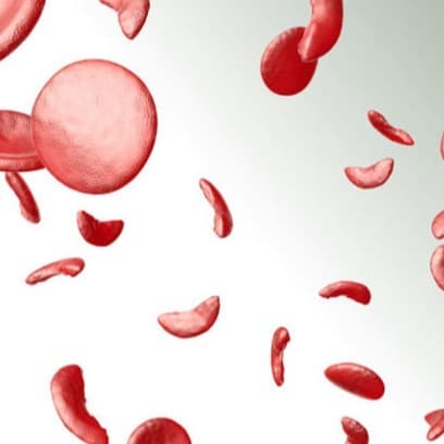 Sickle Cell Disease graphic.